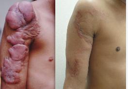 BurnScars