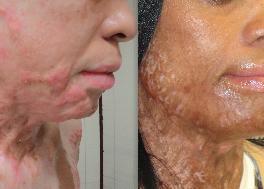 BurnScars2